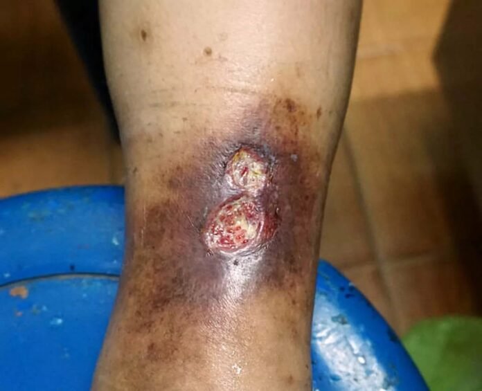 buruli-ulcer-causes-symptoms-and-treatme