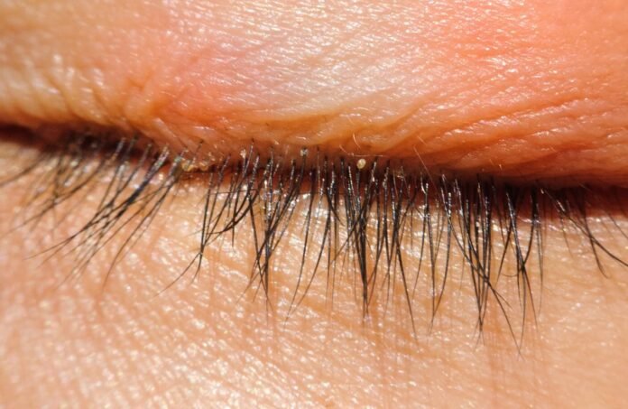 demodex-blepharitis-a-closer-look-at-cau