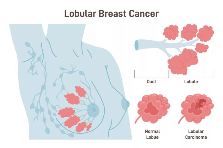 Invasive Lobular Carcinoma (ILC) – Everything You Need To Know