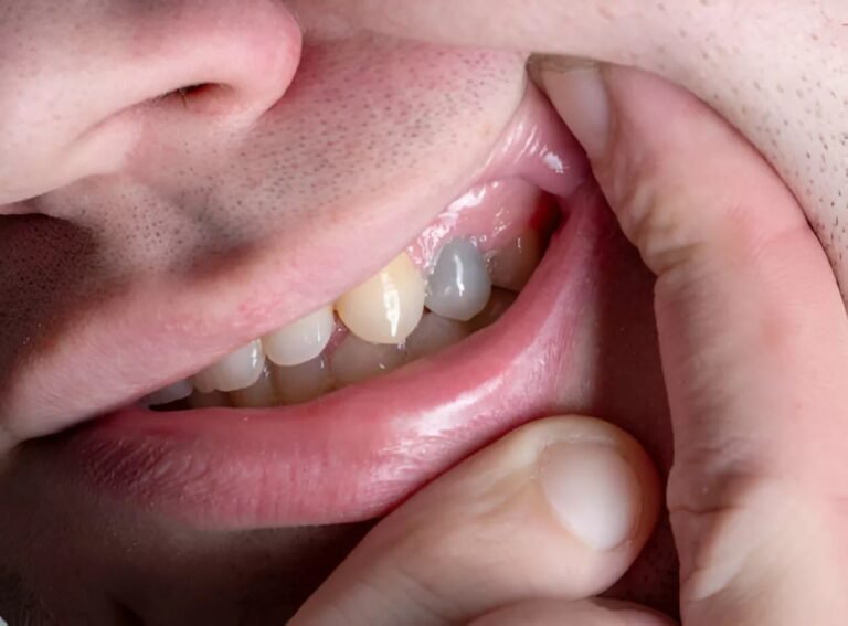 Dental Pulp Necrosis: Causes, Symptoms & Treatment Explained