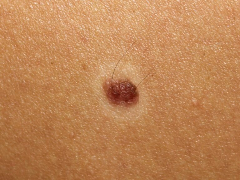 Halo Nevus: Understanding Causes, Diagnosis & Treatment