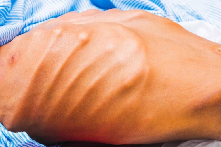 Cachexia: Understanding the Wasting Syndrome & Its Impact