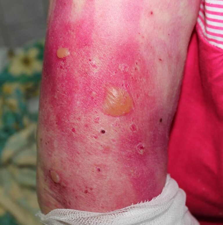 Bullous Pemphigoid: Understanding Causes & Treatment