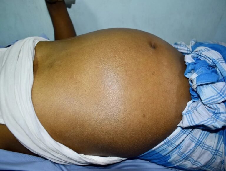 Ascites: Why It Happens & How It’s Treated