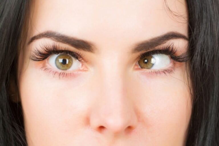 Strabismus: Understanding & Treating Eye Misalignment