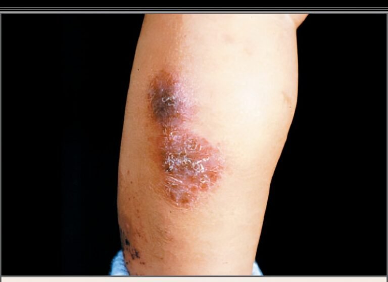 Nummular Eczema: Understanding and Managing Skin Discomfort
