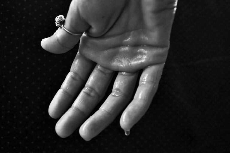 Palmar Hyperhidrosis: Causes, Symptoms & Solutions
