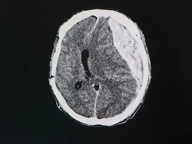 Intracranial Hematoma: Hidden Dangers Revealed