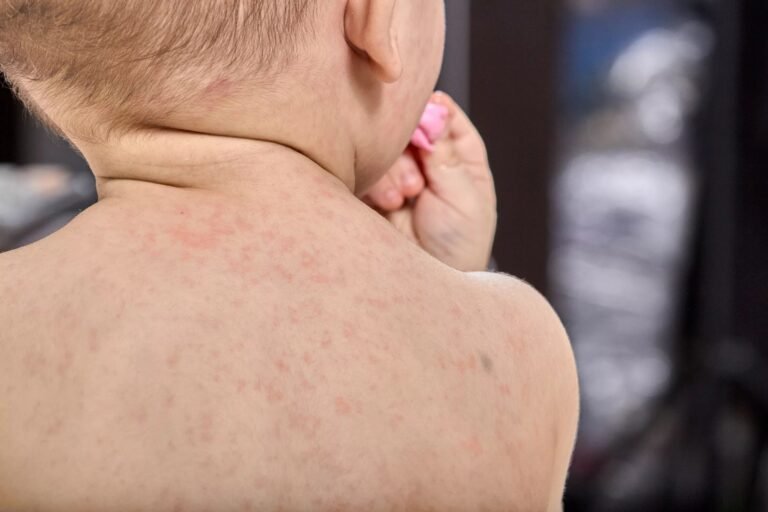Is Roseola Contagious? – An Infection that Affects Children Once in their Lifetime