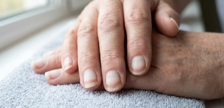 Terry’s Nails: A Window to Systemic Health