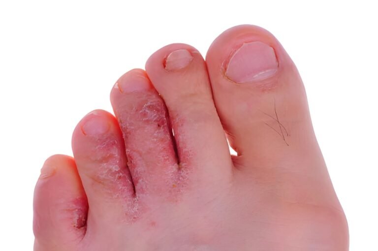 Tinea Pedis: Understand and Treat Athlete’s Foot