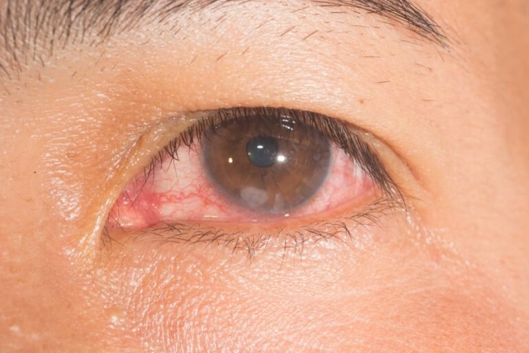 Comprehensive Guide to Understanding Corneal Ulcers: Causes, Symptoms, and Treatment Options