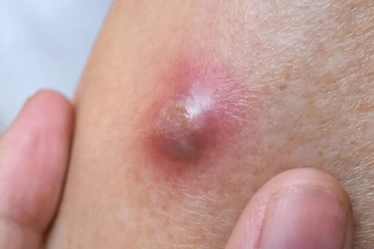 Carbuncle: When Multiple Boils Become a Serious Skin Infection