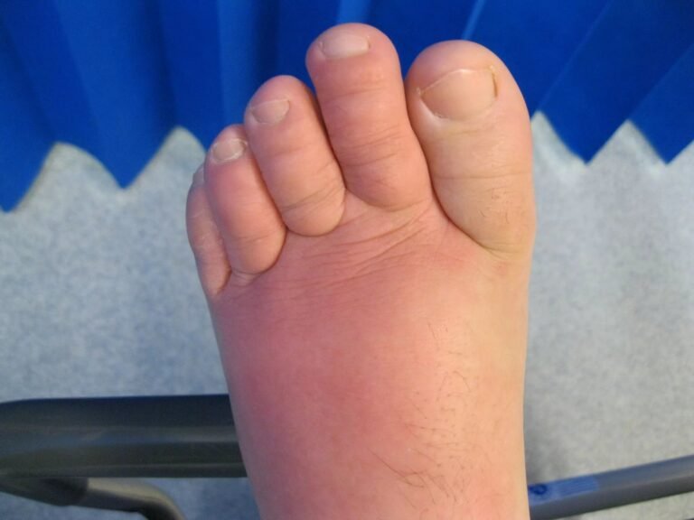 Cellulitis: A Common Skin Infection You Should Know About
