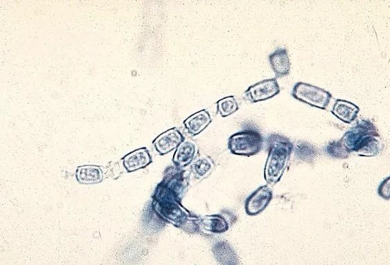 Coccidioidomycosis: From Symptoms to Treatment