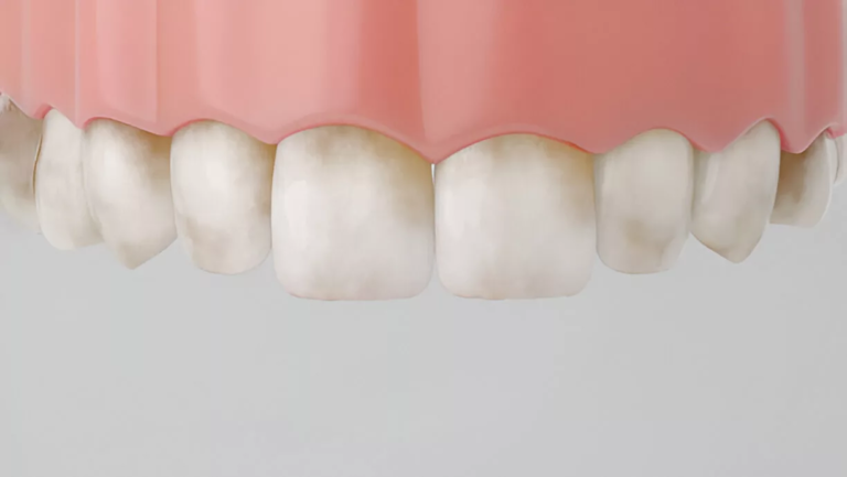 Fluorosis: Causes, Symptoms, and Effective Treatments