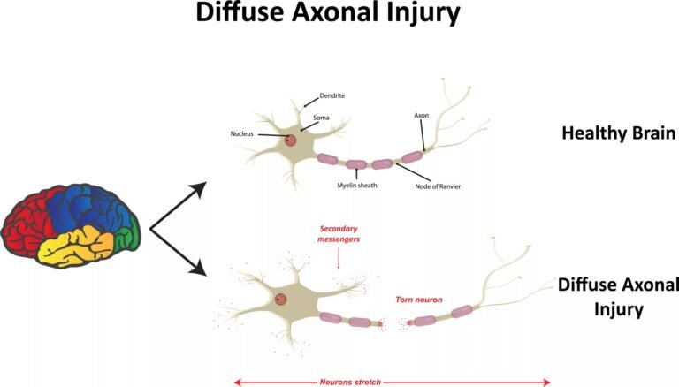 Diffuse Axonal Injury- Etiology, Treatment and Prognosis