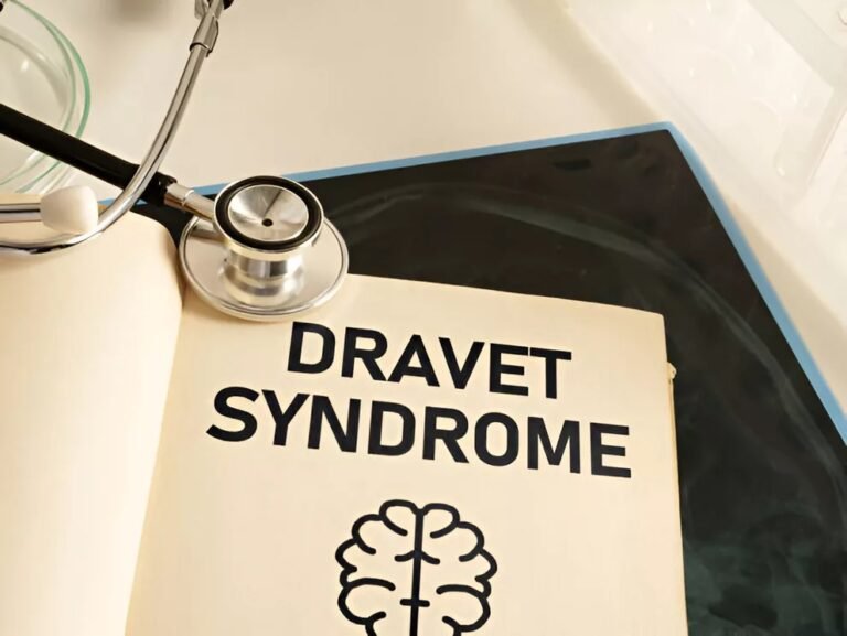 Dravet Syndrome: Understanding This Severe Epilepsy