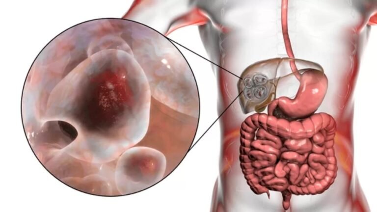 Echinococcosis: How Echinococcus Eggs Cause Hydatid Disease