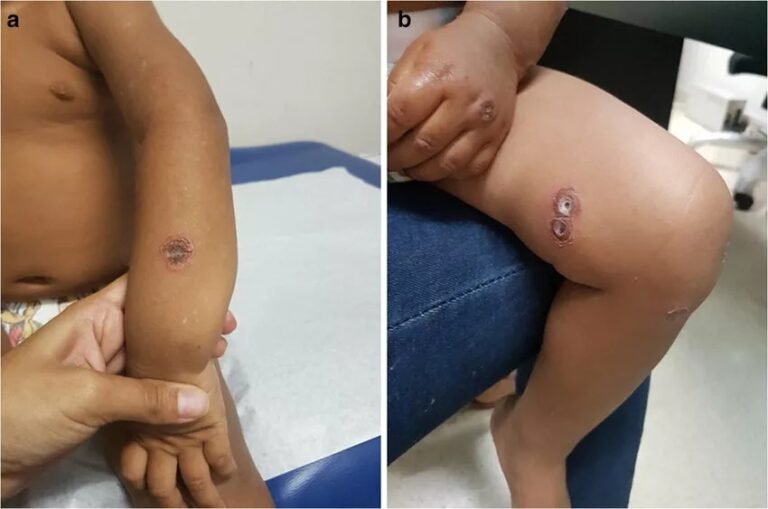 Ecthyma: Understanding This Deep Skin Infection
