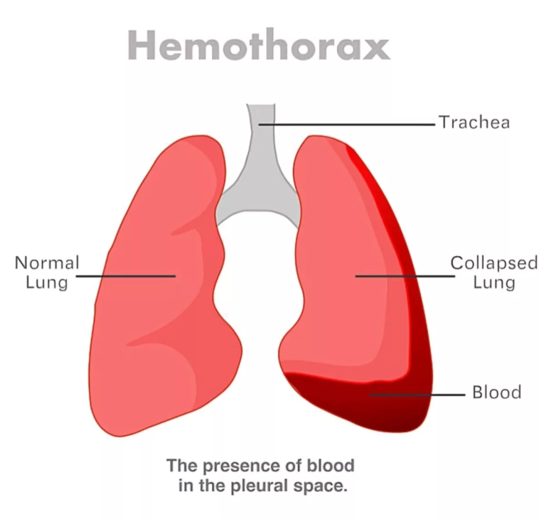 Hemothorax: Causes, Symptoms, and Treatment Options