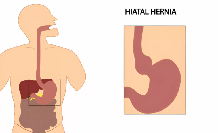 Hiatal Hernia: What It Is and How to Manage It
