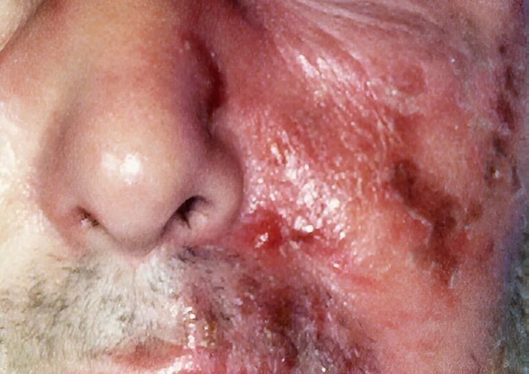 Erysipelas: Symptoms, Causes & Treatment Options