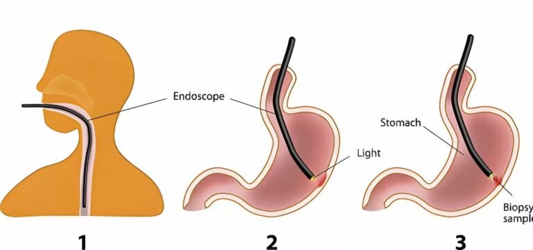 Esophagogastroduodenoscopy: Process & Benefits