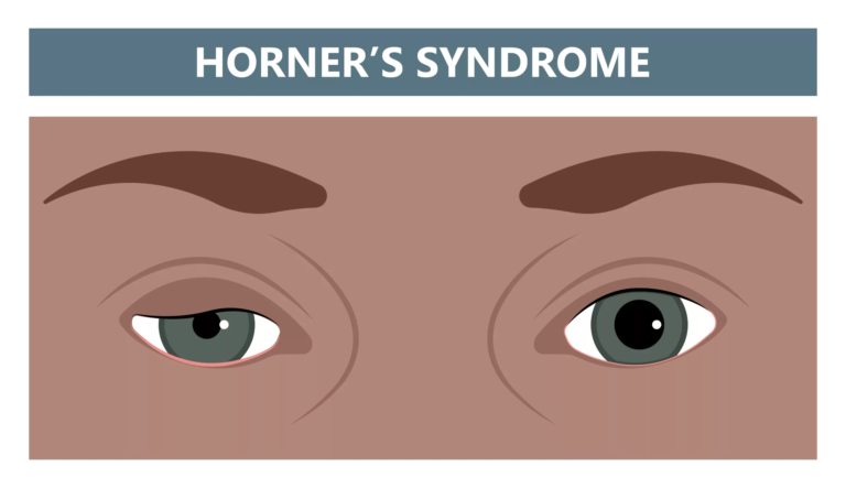Horner’s Syndrome: Causes, Symptoms & Treatment Options