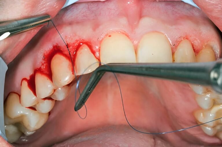 Gingivoplasty: What to Expect from the Procedure
