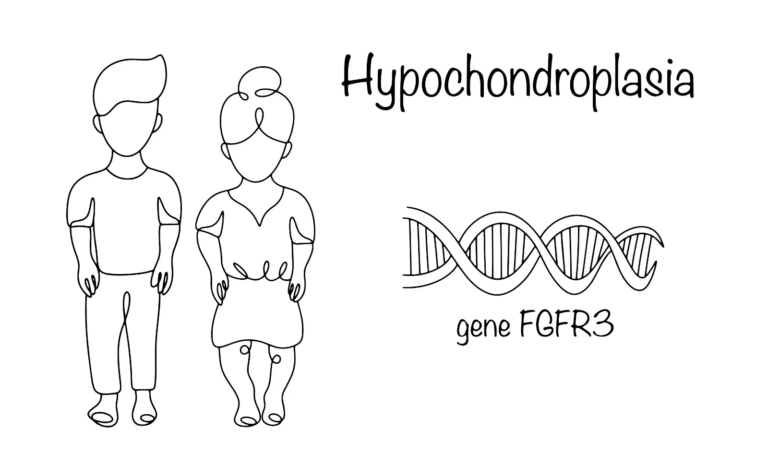 Hypochondroplasia: Understanding Short-Limb Dwarfism