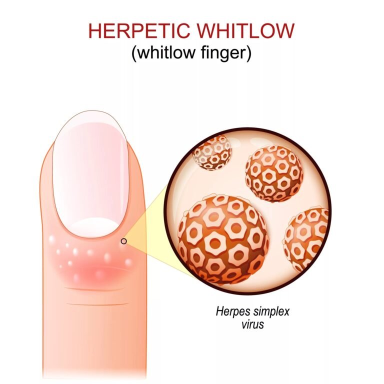 Herpetic Whitlow: Causes, Symptoms & Treatment