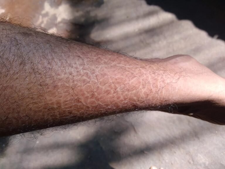 Ichthyosis Vulgaris: Symptoms, Causes & Treatment