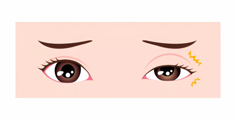 Myokymia: Causes Of The Persistent Eye Twitch