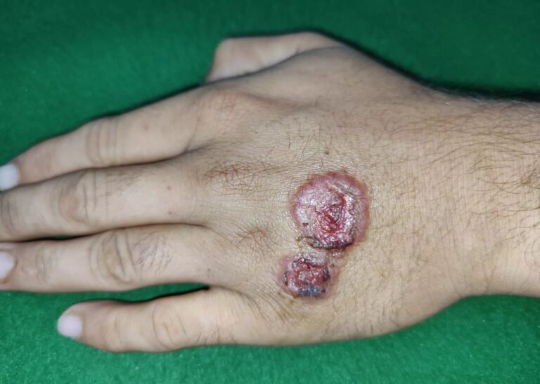 Leishmaniasis: What You Need to Know