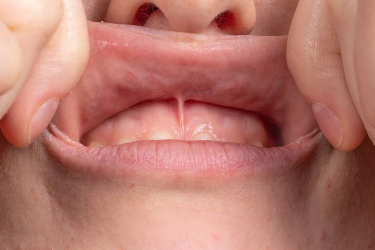 Lip Tie Release: Benefits, Procedure, and Recovery