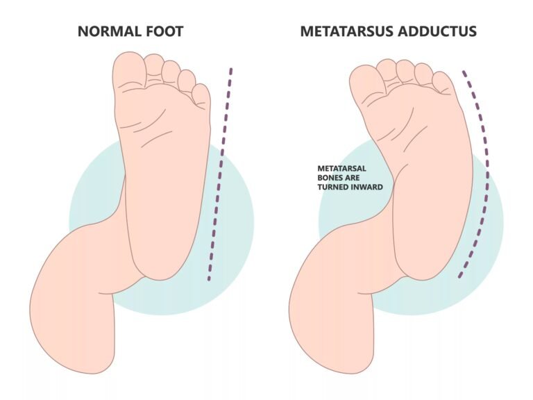 Metatarsus Adductus: Understanding This Common Foot Deformity