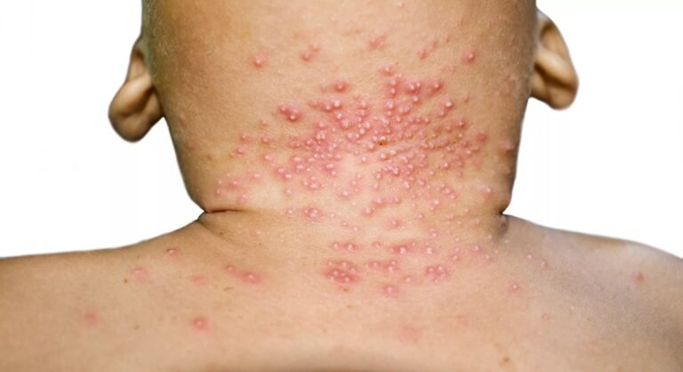Molluscum Contagiosum: Causes, Treatment & Prevention Tips