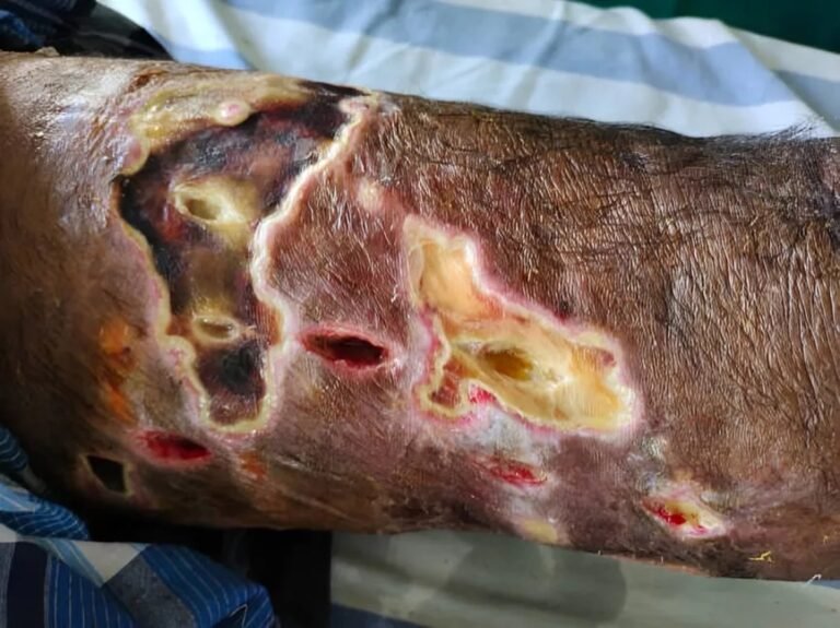 Necrotizing Fasciitis: The Fast-Spreading Flesh Infection