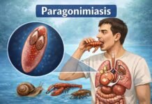 Paragonimiasis: A Comprehensive Guide to Lung Fluke Disease