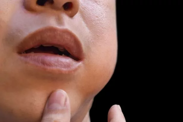 Understanding Mumps Rash: Symptoms, Causes, and Care