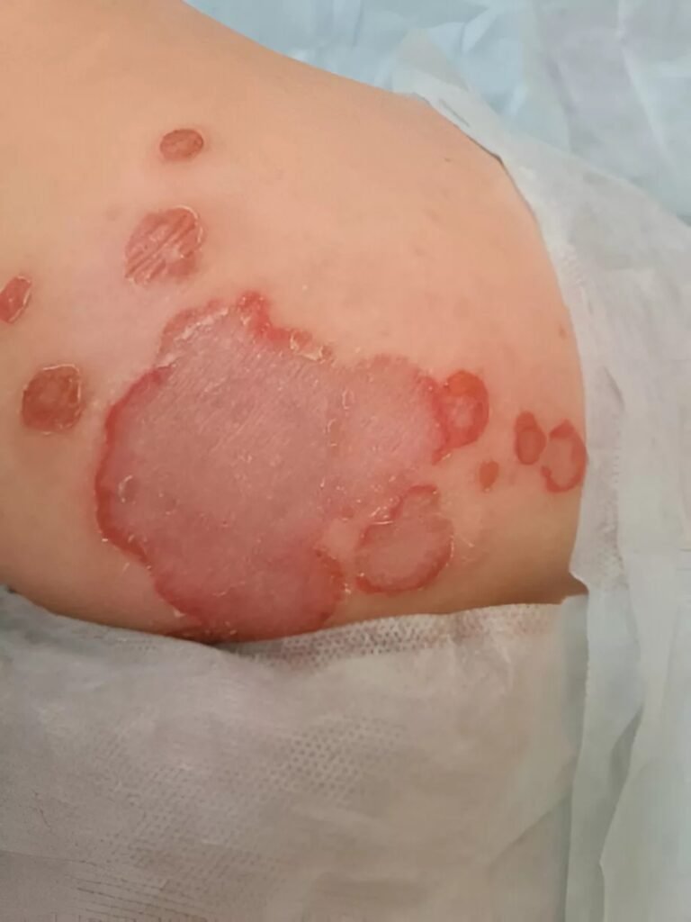 Pemphigus Vulgaris: Key Insights & Treatment Options