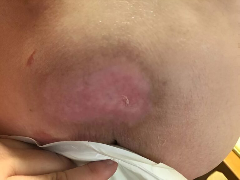 Pressure Ulcers: Causes, Risks, and Prevention