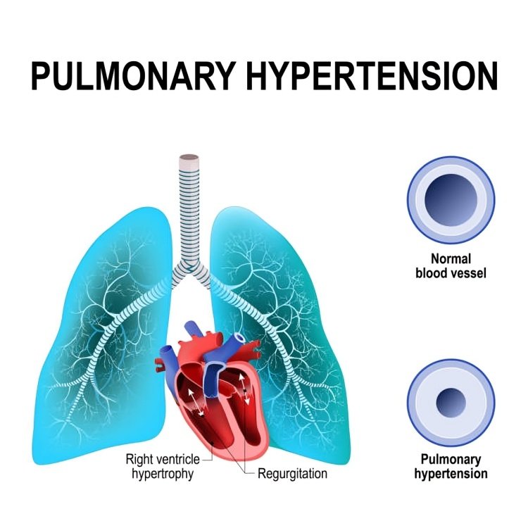 Primary Pulmonary Hypertension: Causes & Treatments