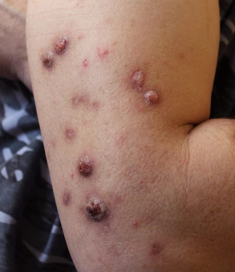 Prurigo Nodularis: Symptoms, Diagnosis & Management Tips
