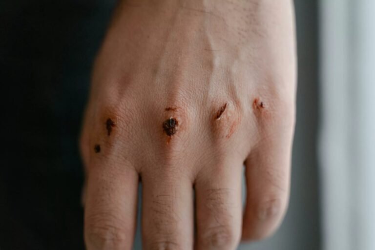 Rickettsialpox: Symptoms, Causes and Treatment