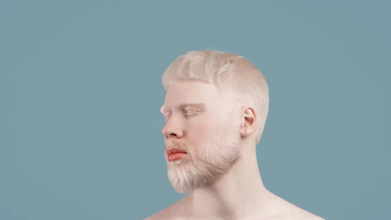 What is Albinism?