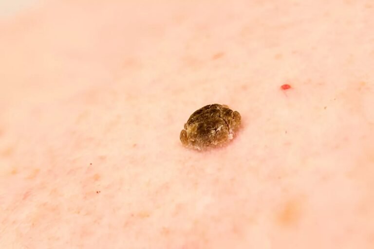 Seborrheic Keratosis: Causes, Signs & Care