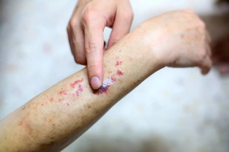 Senile Purpura: Why Aging Skin Bruises Easily?