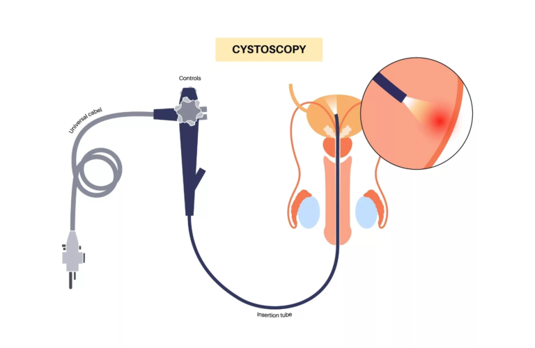 Cystoscopy: Procedure, Purpose, and What to Expect